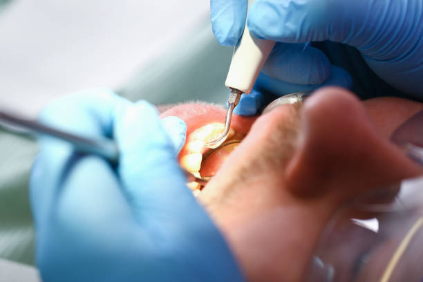 Best Emergency Dental Care for Broken or Chipped Teeth in Fort Pierre, SD